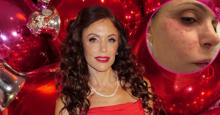 Bethenny Frankel Shows Rash From Bacterial Infection on St. Bart's Trip